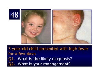 48



3 year-old child presented with high fever
for a few days
Q1. What is the likely diagnosis?
Q2. What is your management?
 