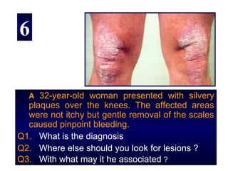 6


  A 32-year-old woman presented with silvery
  plaques over the knees. The affected areas
  were not itchy but gentle removal of the scales
  caused pinpoint bleeding.
Q1. What is the diagnosis
Q2. Where else should you look for lesions ?
Q3. With what may it he associated ?
 