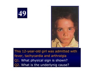 49



This 12-year-old girl was admitted with
fever, tachycardia and arthralgia
Q1. What physical sign is shown?
Q2. What is the underlynig cause?
 