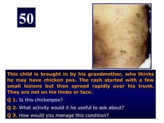 50


This child is brought in by his grandmother, who thinks
he may have chicken pox. The rash started with a few
small lesions but then spread rapidly over his trunk.
They are not on his limbs or face.
Q 1. Is this chickenpox?
Q 2. What activity would it he useful to ask about?
Q 3. How would you manage this condition?
 