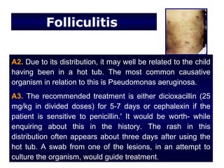 Folliculitis


A2. Due to its distribution, it may well be related to the child
having been in a hot tub. The most common causative
organism in relation to this is Pseudomonas aeruginosa.
A3. The recommended treatment is either dicioxacillin (25
mg/kg in divided doses) for 5-7 days or cephalexin if the
patient is sensitive to penicillin.' It would be worth- while
enquiring about this in the history. The rash in this
distribution often appears about three days after using the
hot tub. A swab from one of the lesions, in an attempt to
culture the organism, would guide treatment.
 