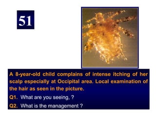 51


A 8-year-old child complains of intense itching of her
scalp especially at Occipital area. Local examination of
the hair as seen in the picture.
Q1. What are you seeing, ?
Q2. What is the management ?
 