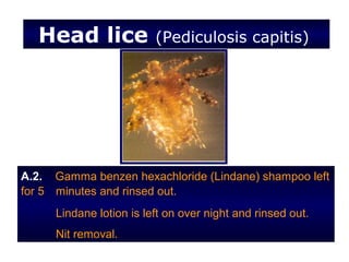 Head lice              (Pediculosis capitis)




A.2. Gamma benzen hexachloride (Lindane) shampoo left
for 5 minutes and rinsed out.
     Lindane lotion is left on over night and rinsed out.
     Nit removal.
 