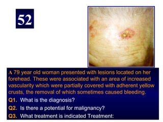 52


A 79 year old woman presented with lesions located on her
forehead. These were associated with an area of increased
vascularity which were partially covered with adherent yellow
crusts, the removal of which sometimes caused bleeding.
Q1. What is the diagnosis?
Q2. Is there a potential for malignancy?
Q3. What treatment is indicated Treatment:
 