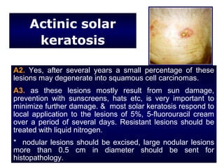 Actinic solar
     keratosis

A2. Yes, after several years a small percentage of these
lesions may degenerate into squamous cell carcinomas.
A3. as these lesions mostly result from sun damage,
prevention with sunscreens, hats etc, is very important to
minimize further damage. & most solar keratosis respond to
local application to the lesions of 5%, 5-fluorouracil cream
over a period of several days. Resistant lesions should be
treated with liquid nitrogen.
* nodular lesions should be excised, large nodular lesions
more than 0.5 cm in diameter should be sent for
histopathology.
 