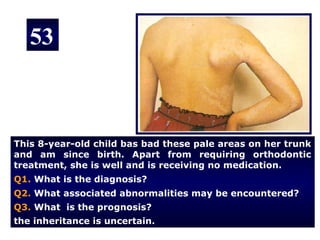53



This 8-year-old child bas bad these pale areas on her trunk
and am since birth. Apart from requiring orthodontic
treatment, she is well and is receiving no medication.
Q1. What is the diagnosis?
Q2. What associated abnormalities may be encountered?
Q3. What is the prognosis?
the inheritance is uncertain.
 