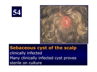 54



Sebaceous cyst of the scalp
clinically infected
Many clinically infected cyst proves
sterile on culture
 