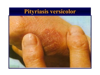 Pityriasis versicolor
 