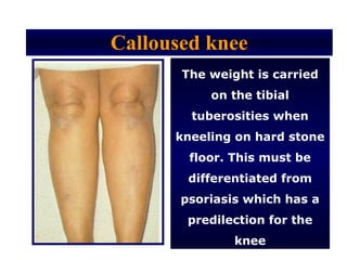 Calloused knee
       The weight is carried
           on the tibial
        tuberosities when
      kneeling on hard stone
        floor. This must be
        differentiated from
       psoriasis which has a
        predilection for the
               knee
 