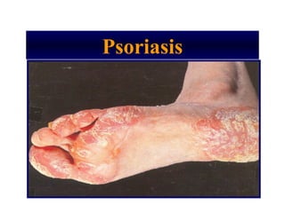 Psoriasis
 