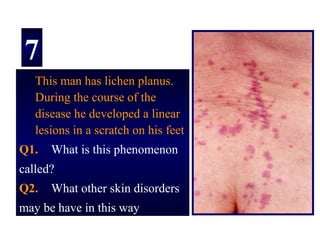 7
   This man has lichen planus.
   During the course of the
   disease he developed a linear
   lesions in a scratch on his feet
Q1.   What is this phenomenon
called?
Q2.   What other skin disorders
may be have in this way
 