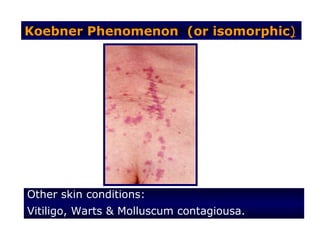 Koebner Phenomenon (or isomorphic)




Other skin conditions:
Vitiligo, Warts & Molluscum contagiousa.
 