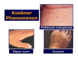 Koebner
Phenomenon

                 Molluscum contagiosum




  Planer warts          Psoriasis
 