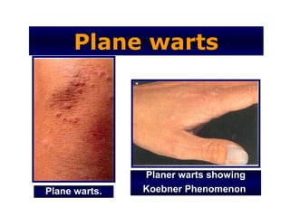 Plane warts




               Planer warts showing
Plane warts.   Koebner Phenomenon
 