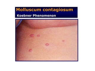 Molluscum contagiosum
Koebner Phenomenon
 