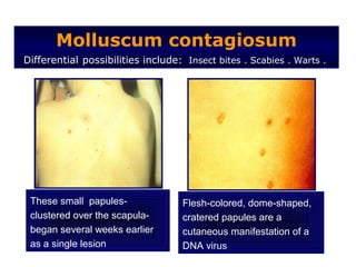 Molluscum contagiosum
Differential possibilities include: Insect bites . Scabies . Warts .




 These small papules-              Flesh-colored, dome-shaped,
 clustered over the scapula-       cratered papules are a
 began several weeks earlier       cutaneous manifestation of a
 as a single lesion                DNA virus
 
