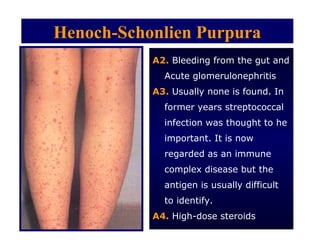 Henoch-Schonlien Purpura
           A2. Bleeding from the gut and
             Acute glomerulonephritis
           A3. Usually none is found. In
             former years streptococcal
             infection was thought to he
             important. It is now
             regarded as an immune
             complex disease but the
             antigen is usually difficult
             to identify.
           A4. High-dose steroids
 