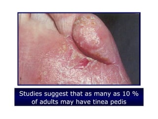 Studies suggest that as many as 10 %
   of adults may have tinea pedis
 