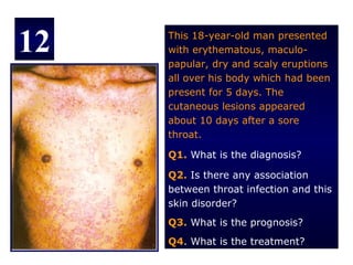 12   This 18-year-old man presented
     with erythematous, maculo-
     papular, dry and scaly eruptions
     all over his body which had been
     present for 5 days. The
     cutaneous lesions appeared
     about 10 days after a sore
     throat.

     Q1. What is the diagnosis?

     Q2. Is there any association
     between throat infection and this
     skin disorder?
     Q3. What is the prognosis?
     Q4. What is the treatment?
 