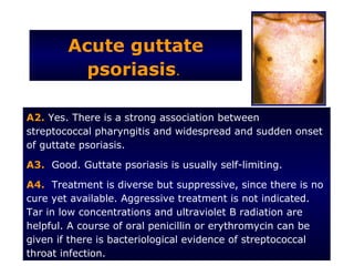 Acute guttate
          psoriasis.

A2. Yes. There is a strong association between
streptococcal pharyngitis and widespread and sudden onset
of guttate psoriasis.

A3. Good. Guttate psoriasis is usually self-limiting.

A4. Treatment is diverse but suppressive, since there is no
cure yet available. Aggressive treatment is not indicated.
Tar in low concentrations and ultraviolet B radiation are
helpful. A course of oral penicillin or erythromycin can be
given if there is bacteriological evidence of streptococcal
throat infection.
 