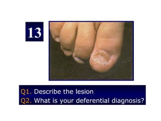 13


Q1. Describe the lesion
Q2. What is your deferential diagnosis?
 