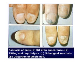 Psoriasis of nails (a) Oil-drop appearance. (b)
Pitting and onycholysis. (c) Subungual keratosis.
(d) Distortion of whole nail.
 