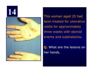 14   This woman aged 25 had
     been treated for ulcerative
     colitis for approximately
     three weeks with steroid
     enema and sulphalazine.


     Q. What are the lesions on
     her hands.
 