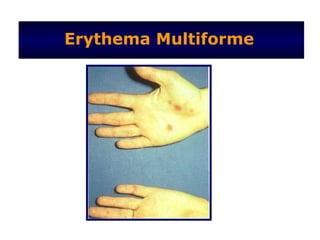 Erythema Multiforme
 