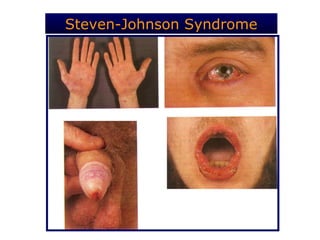 Steven-Johnson Syndrome
 