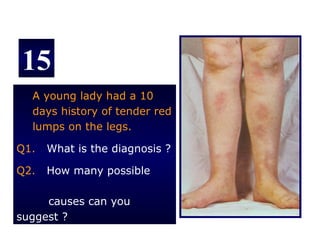 15
  A young lady had a 10
  days history of tender red
  lumps on the legs.

Q1.   What is the diagnosis ?

Q2.   How many possible

     causes can you
suggest ?
 