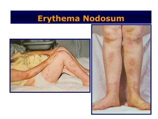 Erythema Nodosum
 