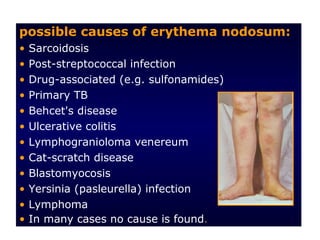 possible causes of erythema nodosum:
•   Sarcoidosis
•   Post-streptococcal infection
•   Drug-associated (e.g. sulfonamides)
•   Primary TB
•   Behcet's disease
•   Ulcerative colitis
•   Lymphogranioloma venereum
•   Cat-scratch disease
•   Blastomyocosis
•   Yersinia (pasleurella) infection
•   Lymphoma
•   In many cases no cause is found.
 