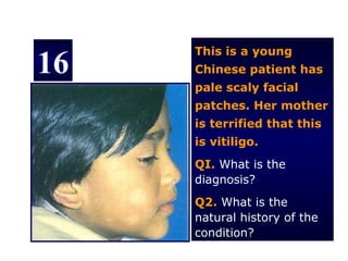 This is a young
16   Chinese patient has
     pale scaly facial
     patches. Her mother
     is terrified that this
     is vitiligo.
     QI. What is the
     diagnosis?
     Q2. What is the
     natural history of the
     condition?
 