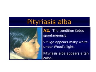 Pityriasis alba
     A2. The condition fades
     spontaneously.

     Vitiligo appears milky white
     under Wood's light.

     Pityriasis alba appears a tan
     color.
 