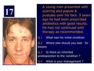A young man presented with

17         scarring and papule &
           pustules over his face. 5 years
           ago he had been prescribed
           antibiotics with good results.
           He had not continued with
           therapy as recommended.
     Q.1     What was his initial condition

     Q.2 Where else should you look for
     lesions

     Q.3 Is there an inherited
     predisposition to the condition ?

     Q.4     What is your management ?
 