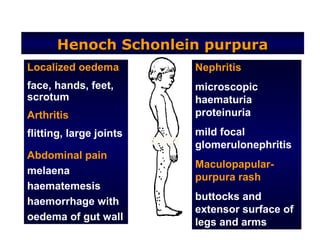 Henoch Schonlein purpura
Localized oedema         Nephritis
face, hands, feet,       microscopic
scrotum                  haematuria
Arthritis                proteinuria
flitting, large joints   mild focal
                         glomerulonephritis
Abdominal pain
                         Maculopapular-
melaena
                         purpura rash
haematemesis
haemorrhage with         buttocks and
                         extensor surface of
oedema of gut wall
                         legs and arms
 