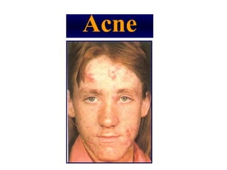 Acne
 