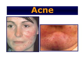 Acne
 