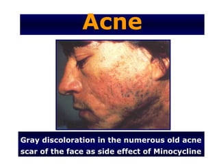 Acne




Gray discoloration in the numerous old acne
scar of the face as side effect of Minocycline
 