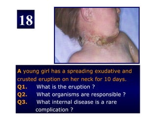 18


A young girl has a spreading exudative and
crusted eruption on her neck for 10 days.
Q1.    What is the eruption ?
Q2.    What organisms are responsible ?
Q3.    What internal disease is a rare
       complication ?
 