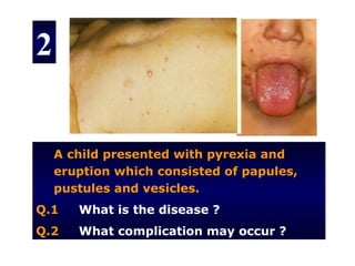 2


    A child presented with pyrexia and
    eruption which consisted of papules,
    pustules and vesicles.
Q.1    What is the disease ?
Q.2    What complication may occur ?
 