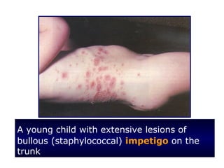 A young child with extensive lesions of
bullous (staphylococcal) impetigo on the
trunk
 