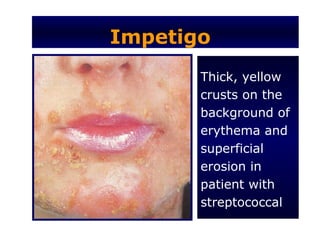 Impetigo
       Thick, yellow
       crusts on the
       background of
       erythema and
       superficial
       erosion in
       patient with
       streptococcal
 