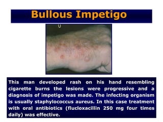 Bullous Impetigo




This man developed rash on his hand resembling
cigarette burns the lesions were progressive and a
diagnosis of impetigo was made. The infecting organism
is usually staphylococcus aureus. In this case treatment
with oral antibiotics (flucloxacillin 250 mg four times
daily) was effective.
 