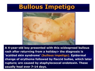 Bullous Impetigo




A 4-year-old boy presented with this widespread bullous
rash after returning from a holiday> the diagnosis is
‘scalded skin syndrome’ (bullous impetigo). Epidermal
change of erythema followed by flaccid bullae, which later
rupture; are caused by staphylococcal endotoxin. These
usually heal over 7-14 days.
 