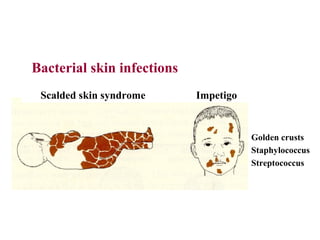 Bacterial skin infections
 Scalded skin syndrome      Impetigo


                                       Golden crusts
                                       Staphylococcus
                                       Streptococcus
 