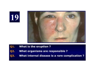 19


Q1.   What is the eruption ?
Q2.   What organisms are responsible ?
Q3.   What internal disease is a rare complication ?
 