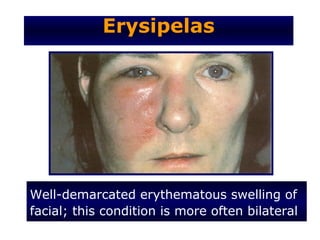 Erysipelas




Well-demarcated erythematous swelling of
facial; this condition is more often bilateral
 