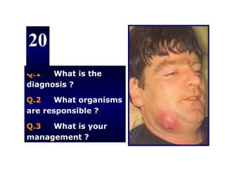20
Q.1   What is the
diagnosis ?

Q.2   What organisms
are responsible ?

Q.3  What is your
management ?
 