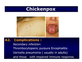 Chickenpox




A2.   Complications :
      Secondary infection:
      Thrombocytopenic purpura Encephalitis
      Varicella pneumonia ( usually in adults)
      and those   with impaired immune response.
 